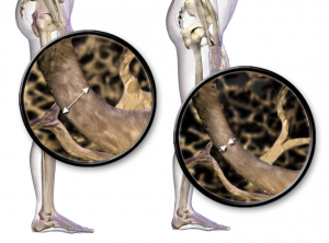 Prise en charge de l’ostéoporose (Présentation)